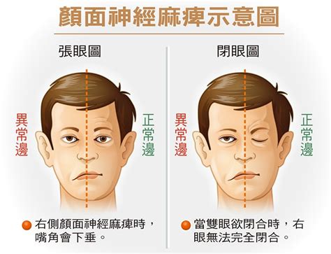 就算只有舌頭能動|臉歪嘴斜，不一定是中風－顏面神經麻痺（懶人包） 